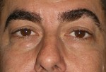 Lower Eyelid Transconjunctival Blepharoplasty