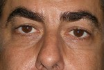 Lower Eyelid Transconjunctival Blepharoplasty