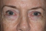 Lower Eyelid Transconjunctival Blepharoplasty