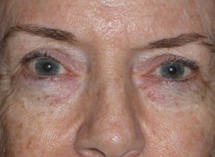 Patient 22 - Before View 