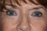 Lower Eyelid Transconjunctival Blepharoplasty