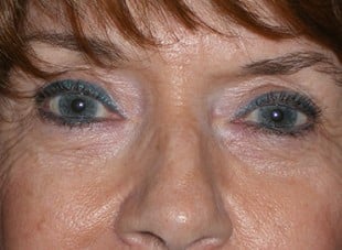 Patient 22 - After View 