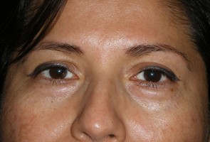 Lower Eyelid Transconjunctival Blepharoplasty