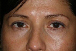 Lower Eyelid Transconjunctival Blepharoplasty