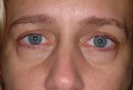 Lower Eyelid Transconjunctival Blepharoplasty