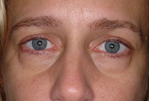 Lower Eyelid Transconjunctival Blepharoplasty