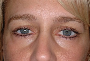 Lower Eyelid Transconjunctival Blepharoplasty