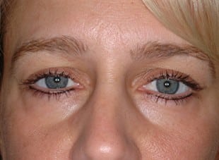 Patient 34 - After View 