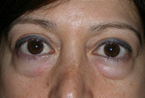 Lower Eyelid Transconjunctival Blepharoplasty