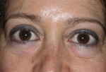 Lower Eyelid Transconjunctival Blepharoplasty