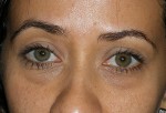 Lower Eyelid Transconjunctival Blepharoplasty