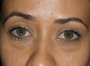 Patient 47 - Before View 