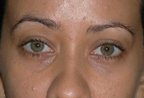 Lower Eyelid Transconjunctival Blepharoplasty