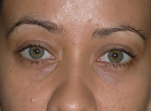 Patient 47 - After View 