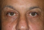 Lower Eyelid Transconjunctival Blepharoplasty