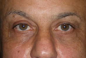 Lower Eyelid Transconjunctival Blepharoplasty