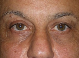 Patient 51 - After View 