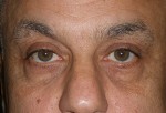 Lower Eyelid Transconjunctival Blepharoplasty