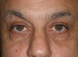 Patient 51 - Before View 
