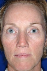 Laser Resurfacing and Fillers