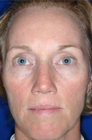 Laser Resurfacing and Fillers