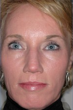 Laser Resurfacing and Fillers