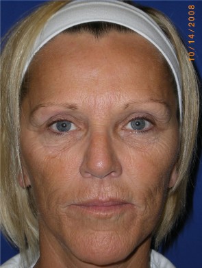 Laser Resurfacing and Fillers