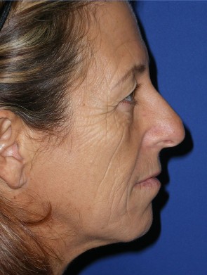 Laser Resurfacing and Fillers