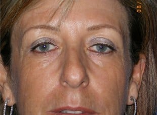Patient 3 - After View 