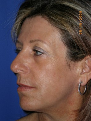 Laser Resurfacing and Fillers