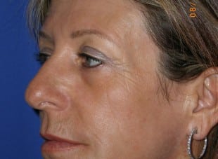Patient 3 - After View 