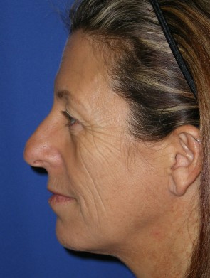 Laser Resurfacing and Fillers