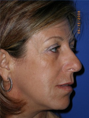 Laser Resurfacing and Fillers