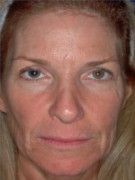 Laser Resurfacing and Fillers