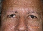 Upper Eyelid Blepharoplasty