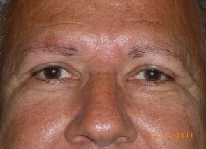 Upper Eyelid Blepharoplasty