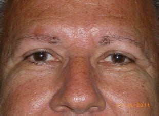 Patient 18 - After View 