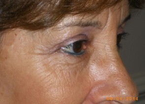 Upper Eyelid Blepharoplasty