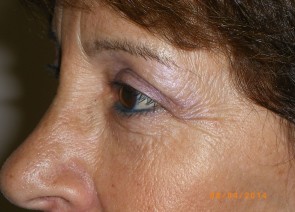 Upper Eyelid Blepharoplasty