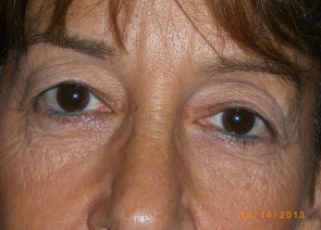 Upper Eyelid Blepharoplasty