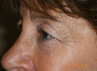 Patient 23 - Before View 