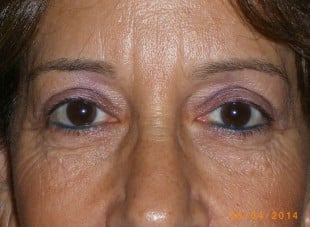 Patient 23 - After View 