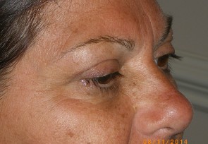 Upper Eyelid Blepharoplasty