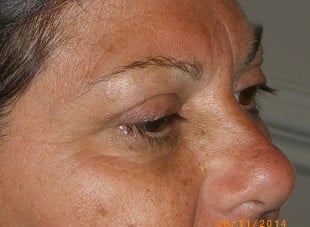 Patient 29 - Before View 