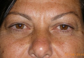 Upper Eyelid Blepharoplasty