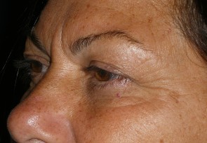 Upper Eyelid Blepharoplasty