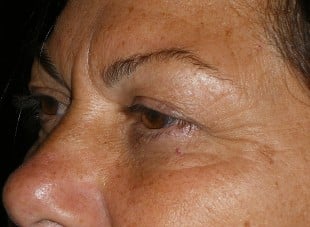 Patient 29 - After View 