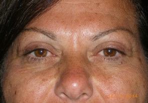 Upper Eyelid Blepharoplasty