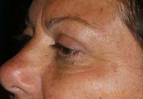 Upper Eyelid Blepharoplasty