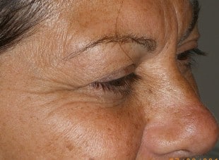 Patient 29 - After View 